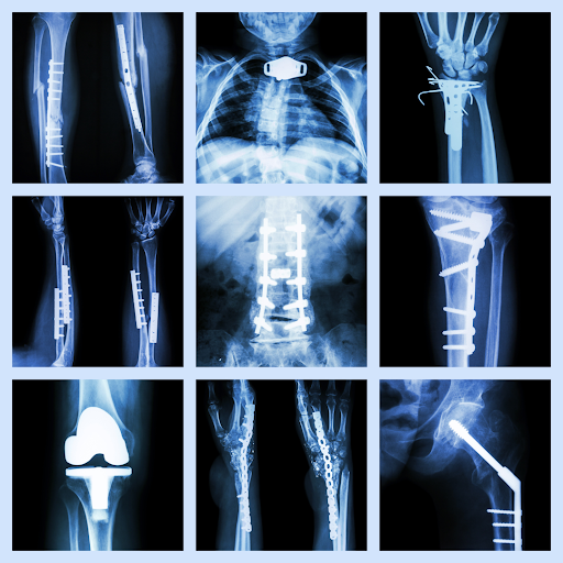 X-Ray image of orthopedic trauma repairs - Orthopedic Specialists